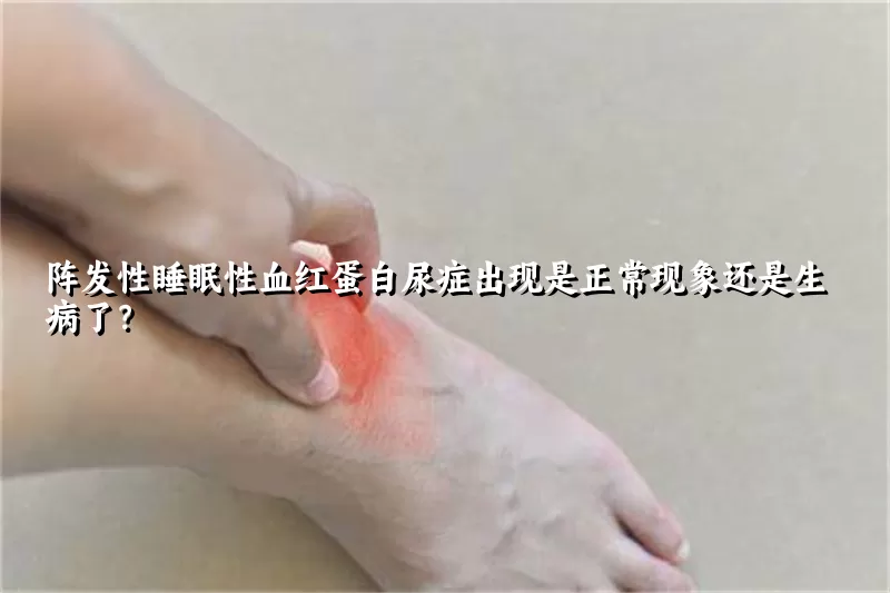 阵发性睡眠性血红蛋白尿症出现是正常现象还是生病了？